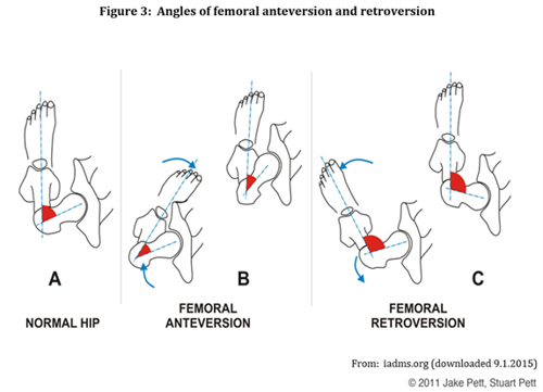 Diagram showing angles of femoral anteversion and retroversion