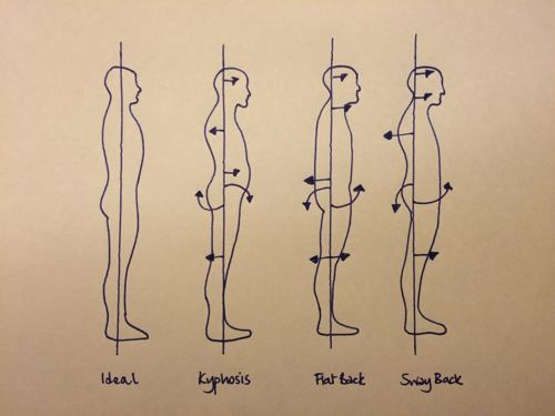 Illustration showing effects of poor head position