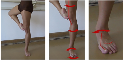 An example of a dancer with hyperpronation of the foot